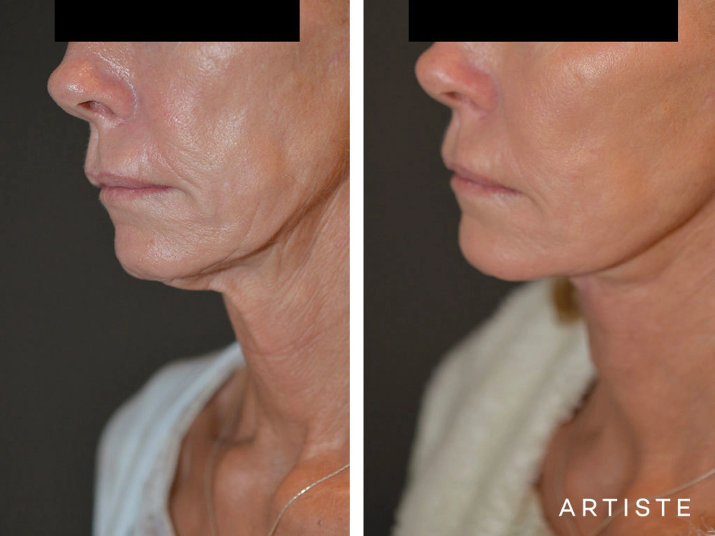 61 Year Old Neck Lift