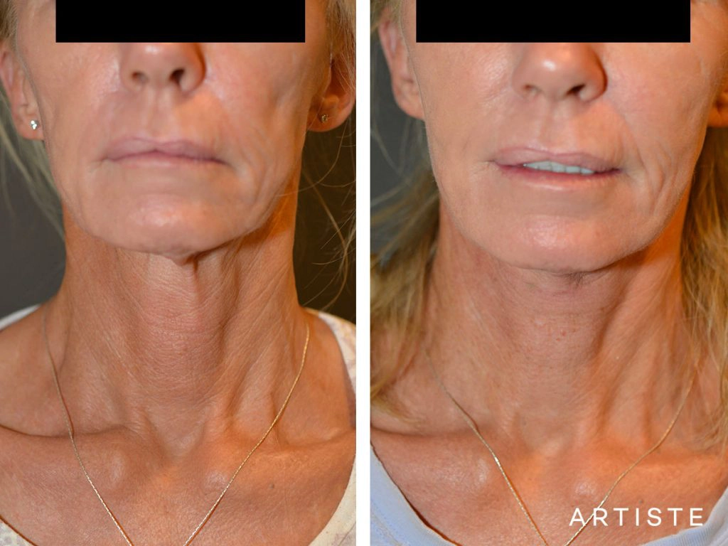 61 Year Old Neck Lift