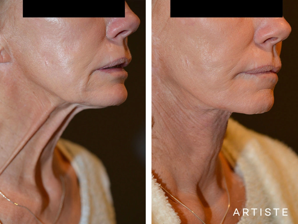 61 Year Old Neck Lift