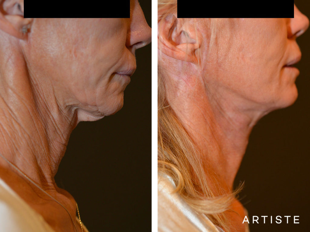 61 Year Old Neck Lift
