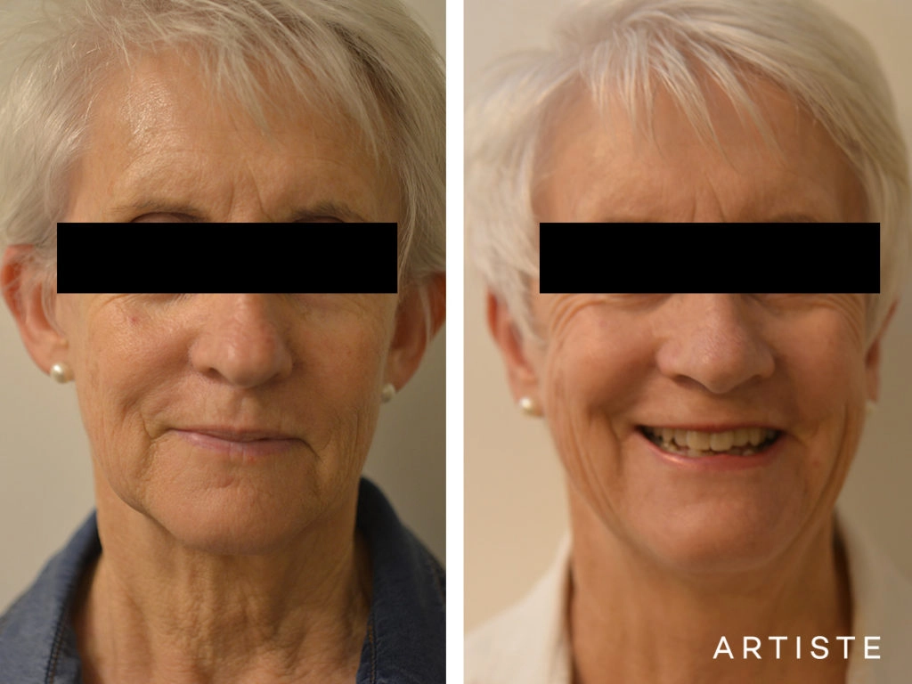 67 Years Old Bilateral Otoplasty