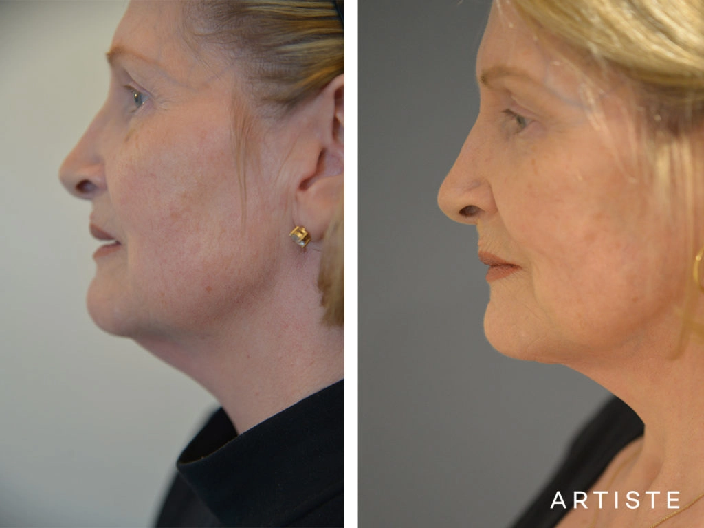 67 Year Old Neck Lift