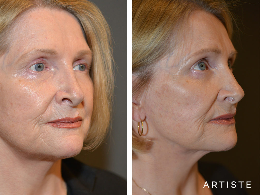 67 Year Old Neck Lift