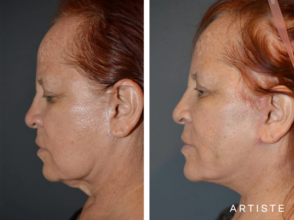 67 Year Old Neck Lift