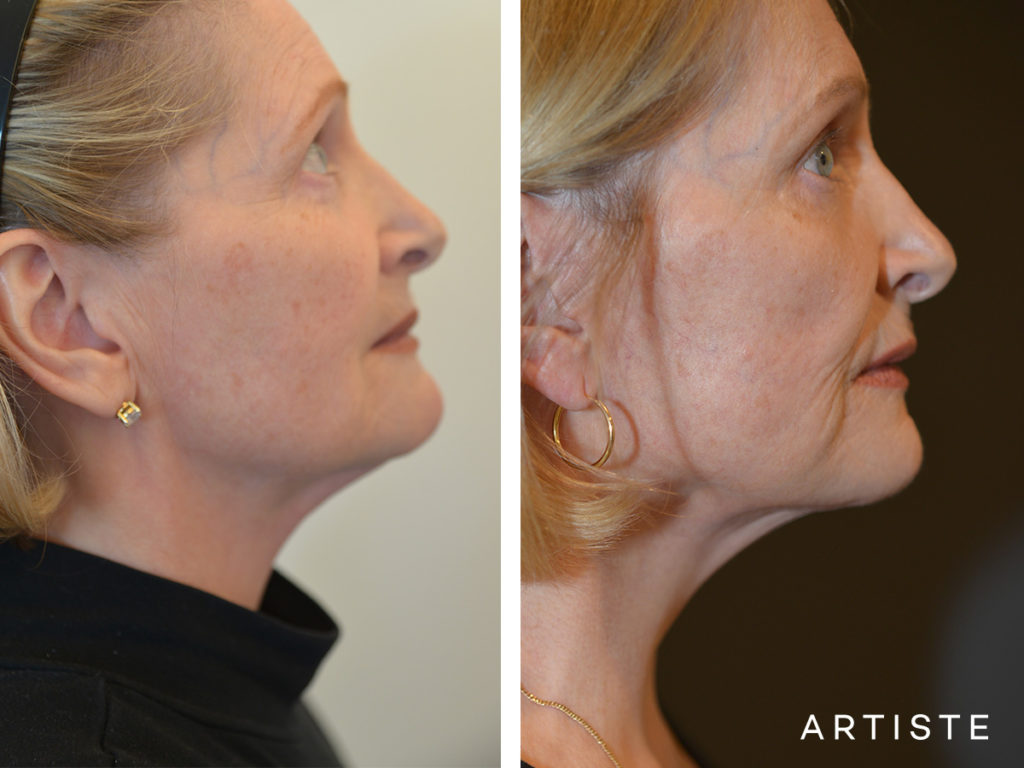 67 Year Old Neck Lift