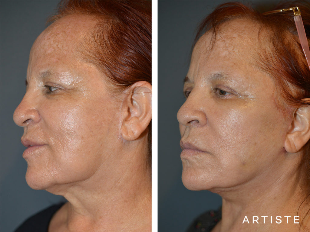 67 Year Old Neck Lift