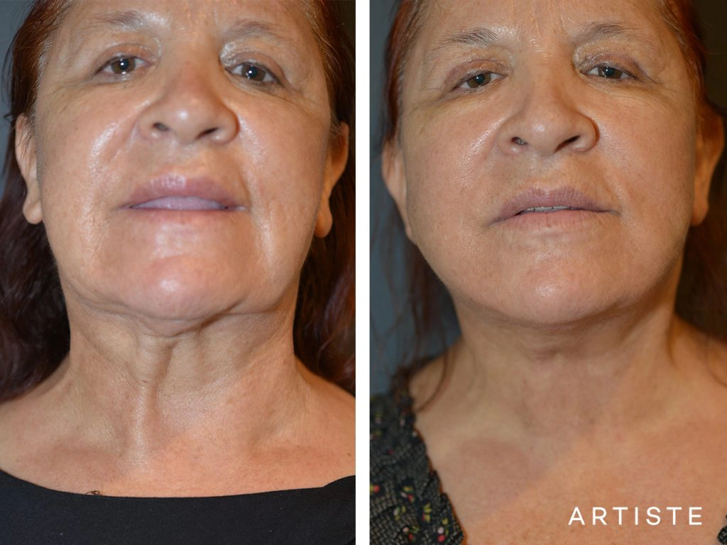 67 Year Old Neck Lift