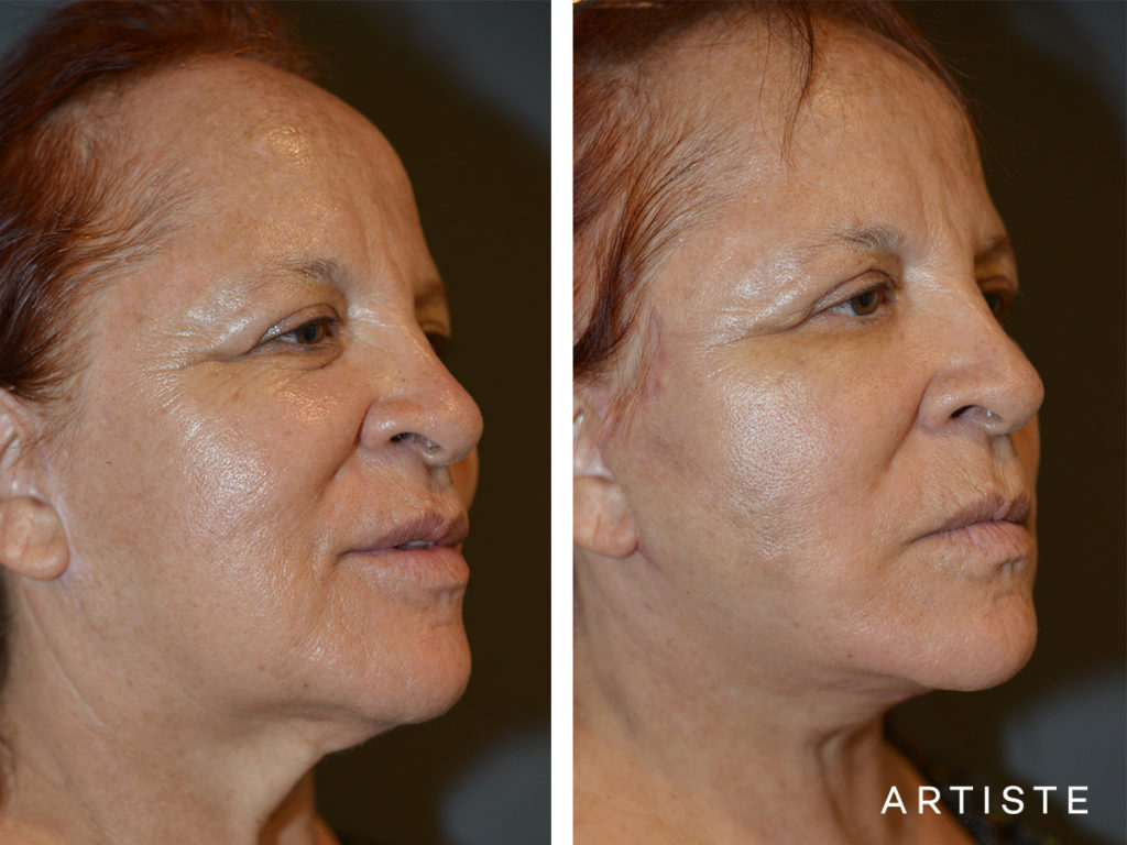 67 Year Old Neck Lift
