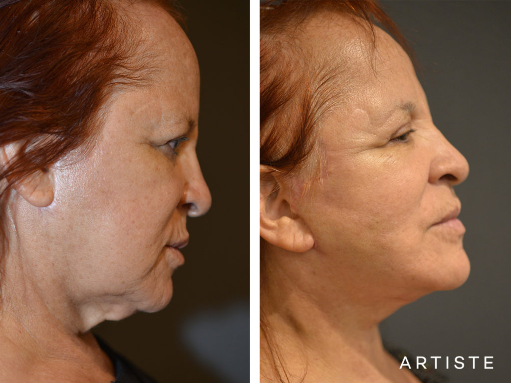 67 Year Old Neck Lift