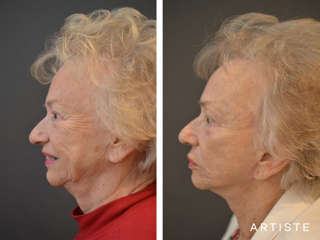 78 Years Old: High SMAS Face and Neck Lift, Structural Fat Grafting, Peri-Oral Dermabrasion, Chemical Peel
