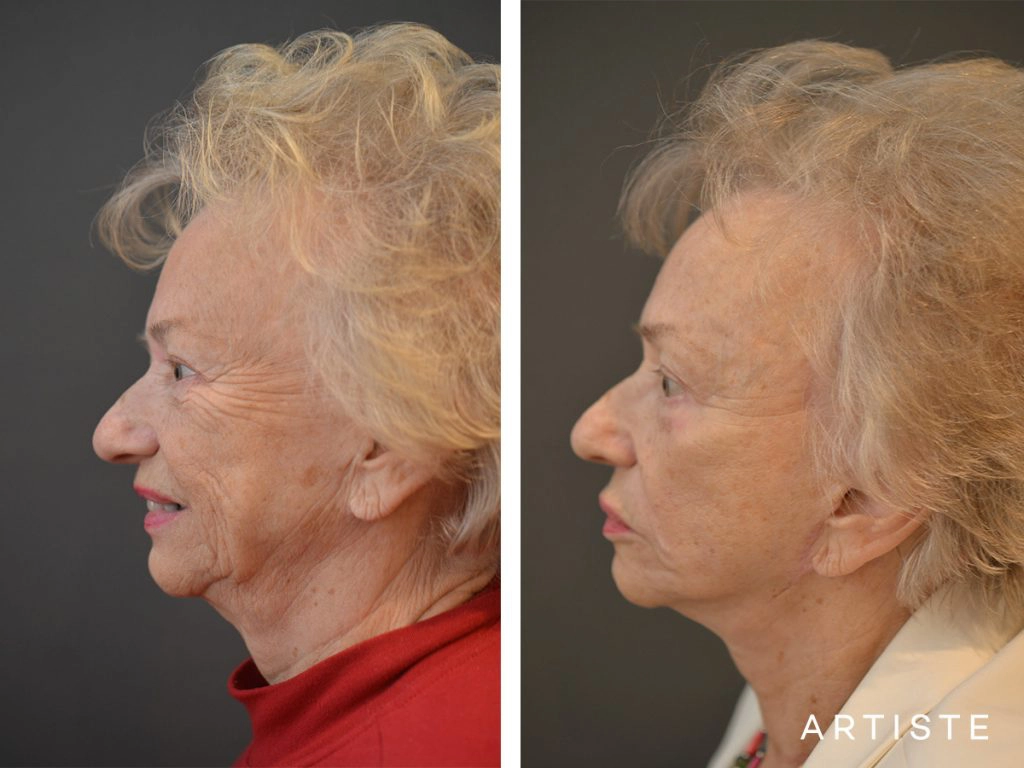 78 Years Old: High SMAS Face and Neck Lift, Structural Fat Grafting, Peri-Oral Dermabrasion, Chemical Peel