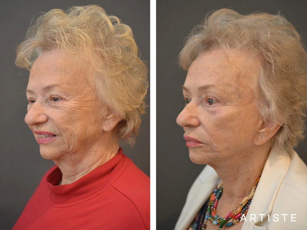 78 Years Old: High SMAS Face and Neck Lift, Structural Fat Grafting, Peri-Oral Dermabrasion, Chemical Peel