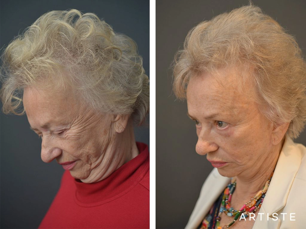 78 Years Old: High SMAS Face and Neck Lift, Structural Fat Grafting, Peri-Oral Dermabrasion, Chemical Peel