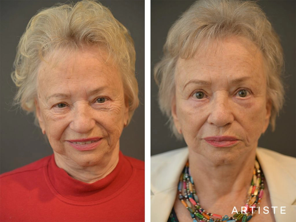 78 Years Old: High SMAS Face and Neck Lift, Structural Fat Grafting, Peri-Oral Dermabrasion, Chemical Peel