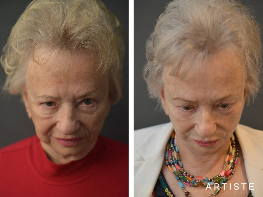 78 Years Old: High SMAS Face and Neck Lift, Structural Fat Grafting, Peri-Oral Dermabrasion, Chemical Peel