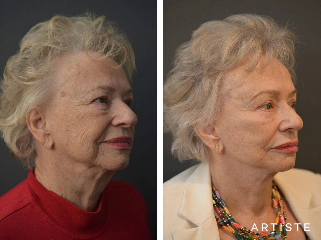 78 Years Old: High SMAS Face and Neck Lift, Structural Fat Grafting, Peri-Oral Dermabrasion, Chemical Peel