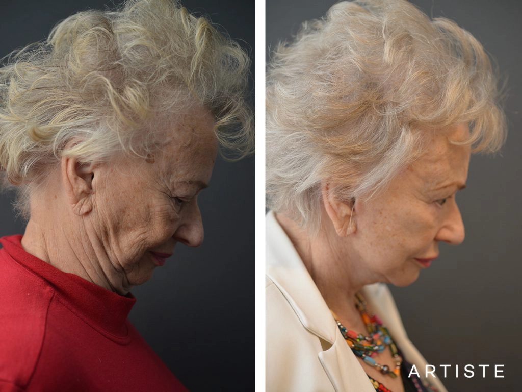 78 Years Old: High SMAS Face and Neck Lift, Structural Fat Grafting, Peri-Oral Dermabrasion, Chemical Peel