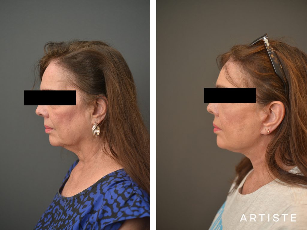 67 Years Old Female Signature Neck Lift