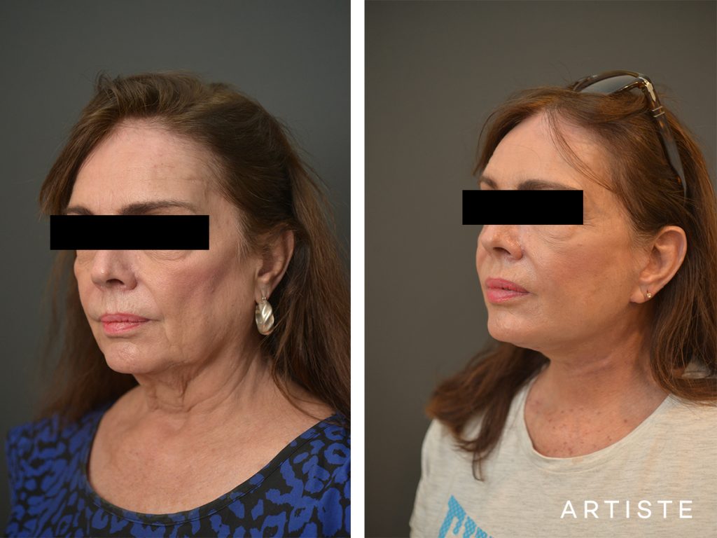 67 Years Old Female Signature Neck Lift