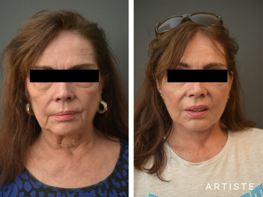 67 Years Old Female Signature Neck Lift