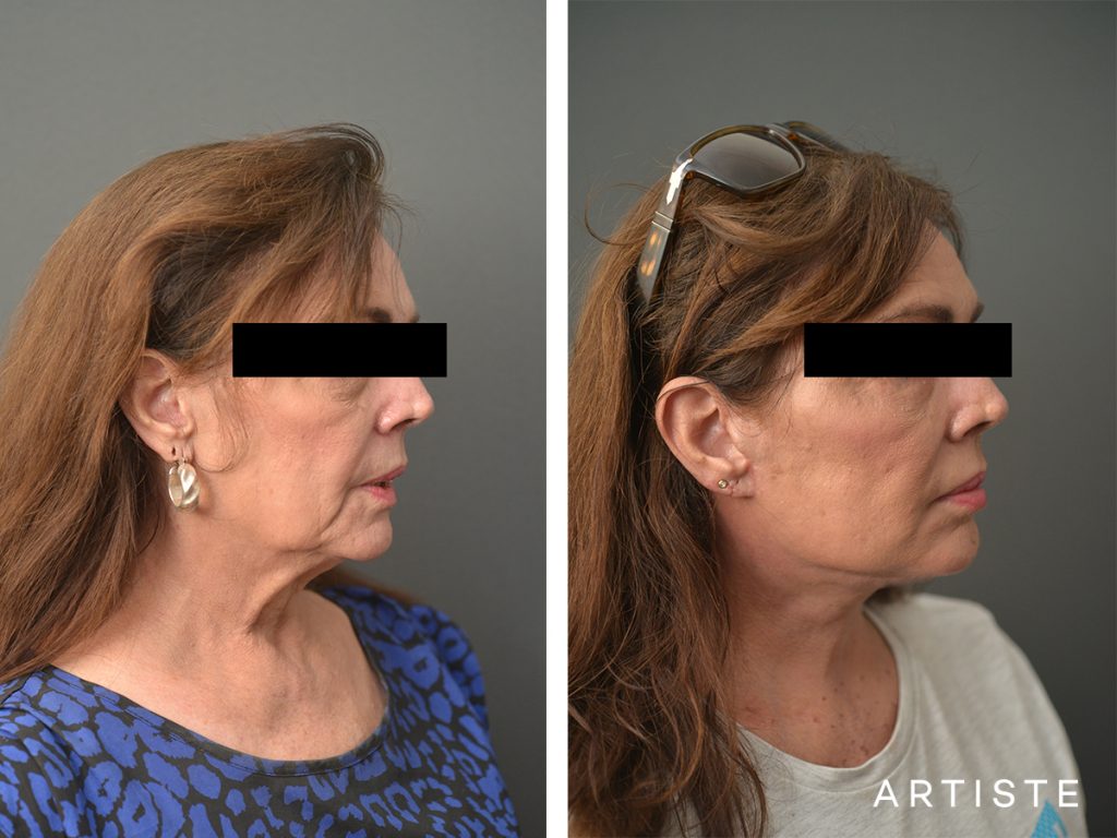 67 Years Old Female Signature Neck Lift