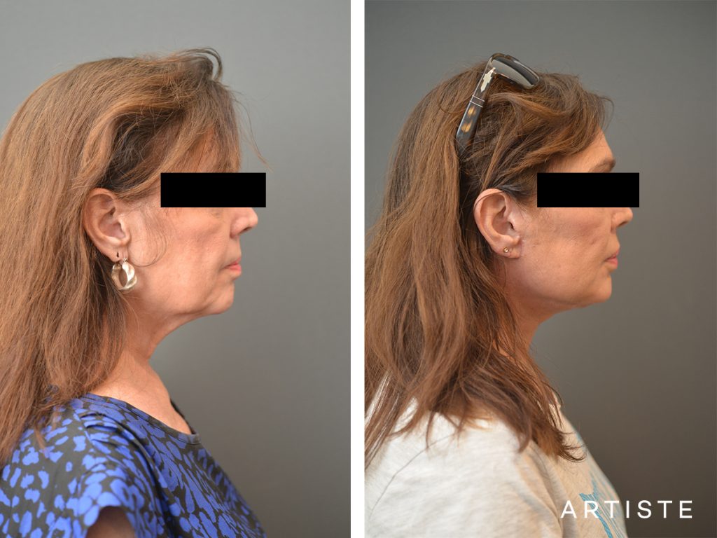 67 Years Old Female Signature Neck Lift