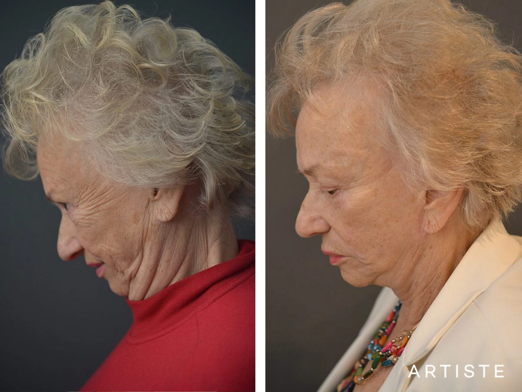 78 Year Old Ultimate Face and Neck Lift