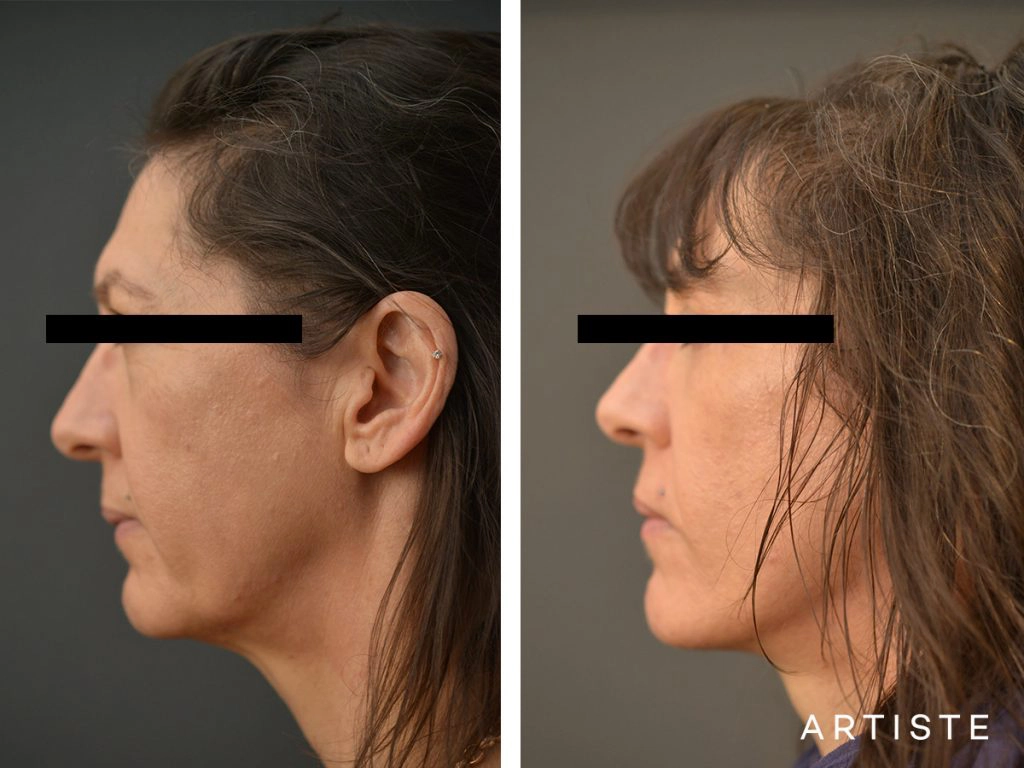 49 Year Old Artiste Short Scar Facelift + Upper + Lower Eyelids: Short Scar SMASectomy, Upper and Lower Eyelid Blepharoplasty