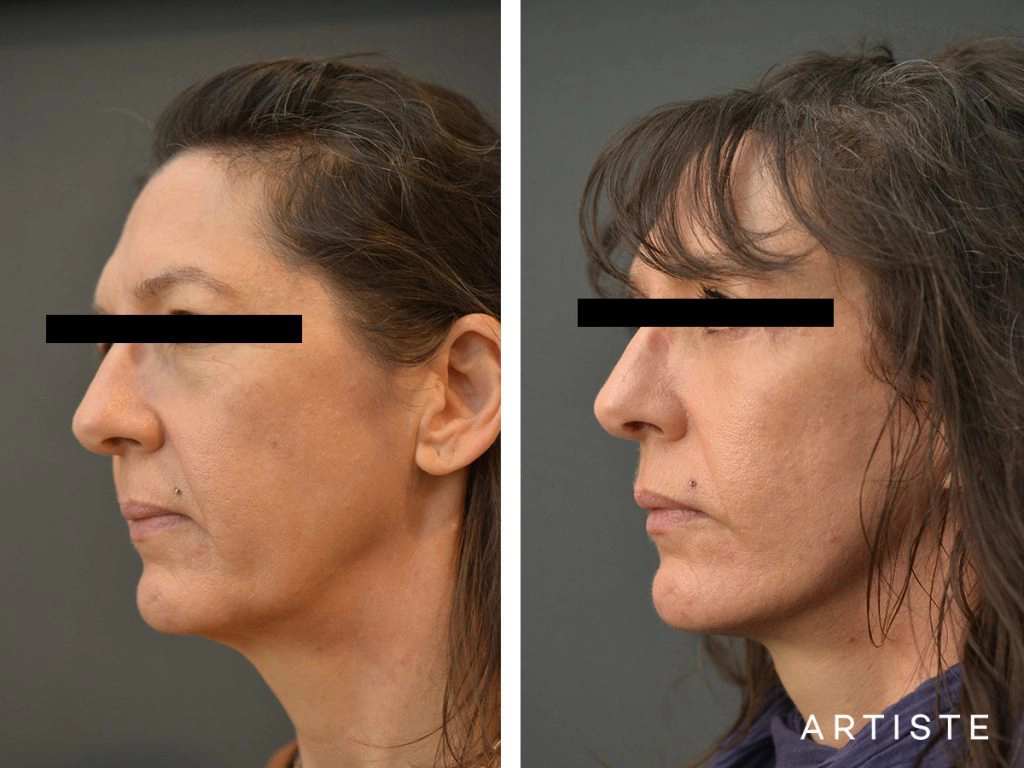 49 Year Old Artiste Short Scar Facelift + Upper + Lower Eyelids: Short Scar SMASectomy, Upper and Lower Eyelid Blepharoplasty