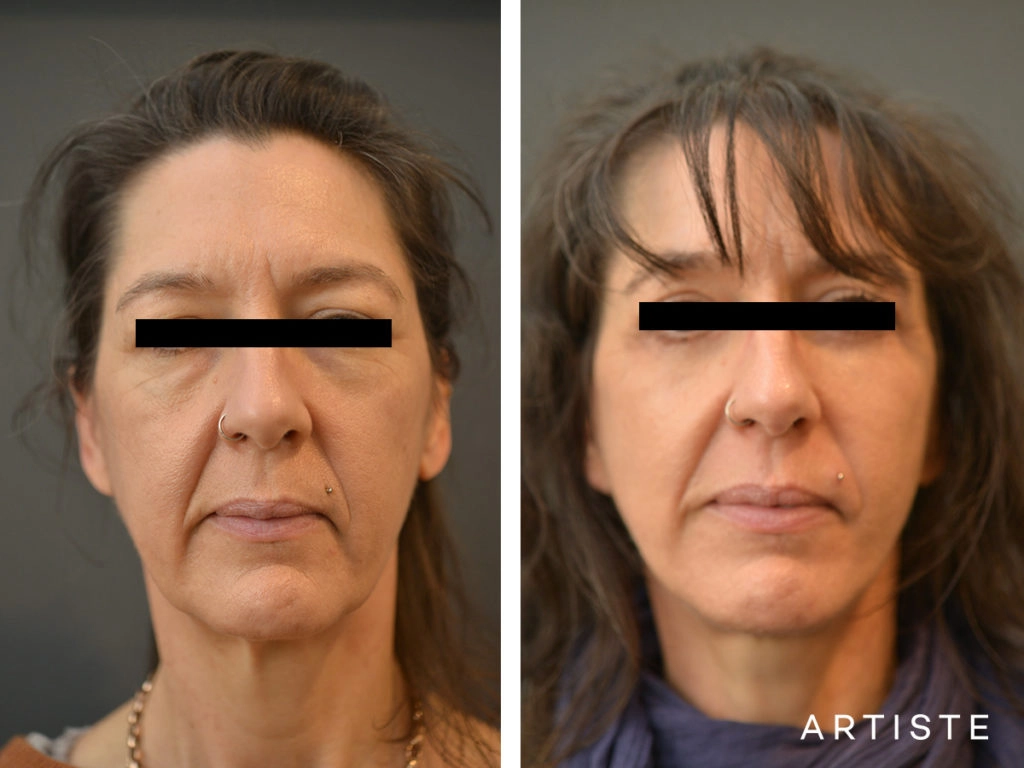 49 Year Old Artiste Short Scar Facelift + Upper + Lower Eyelids: Short Scar SMASectomy, Upper and Lower Eyelid Blepharoplasty