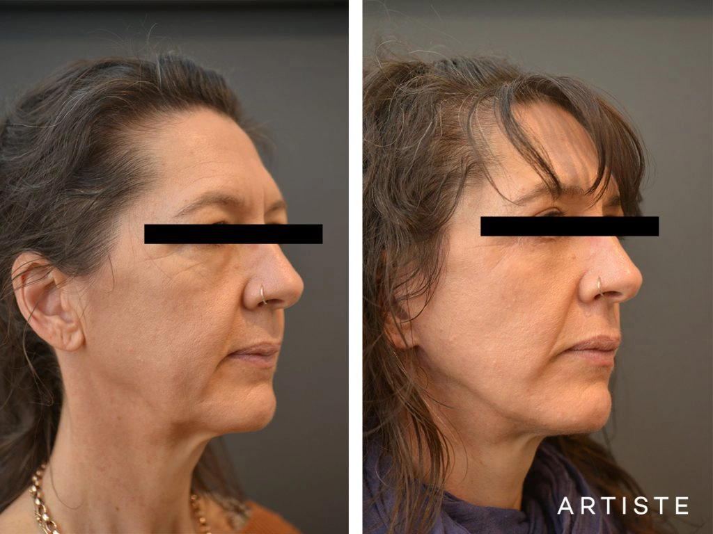 49 Year Old Artiste Short Scar Facelift + Upper + Lower Eyelids: Short Scar SMASectomy, Upper and Lower Eyelid Blepharoplasty