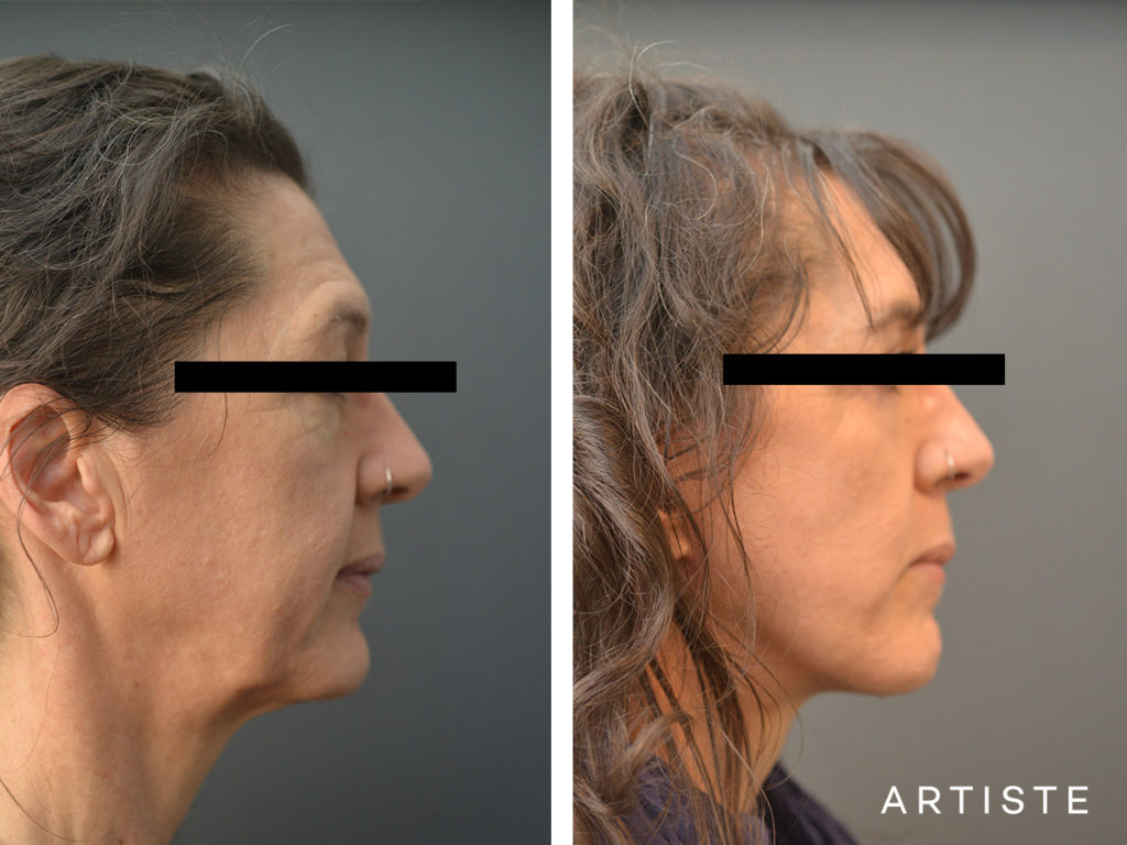 49 Year Old Short Scar Facelift + Upper + Lower Eyelids