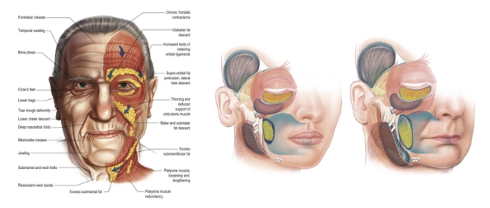 Facelift and the Ageing Process