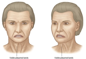 Facial Anatomy - Platysmal Bands