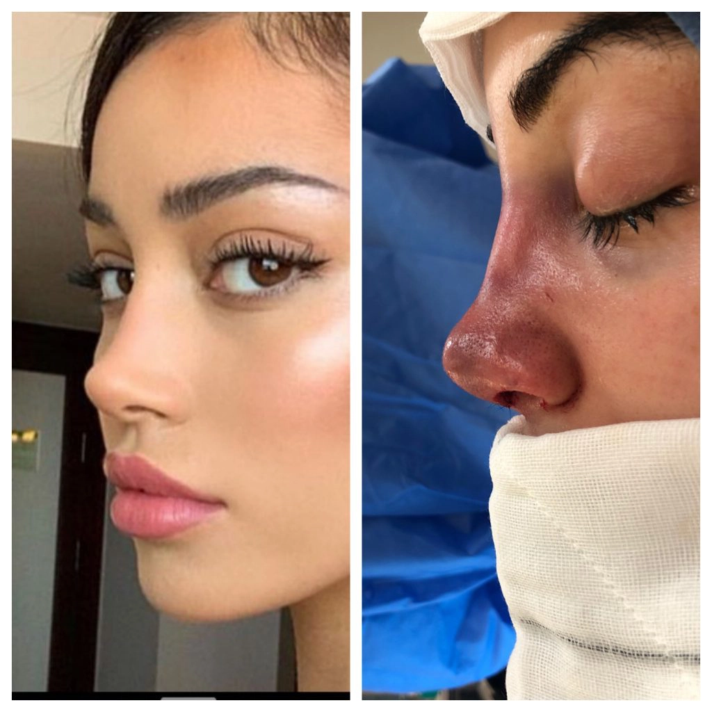 Current Rhinoplasty Trends Sydney