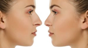 Current Rhinoplasty Trends Sydney