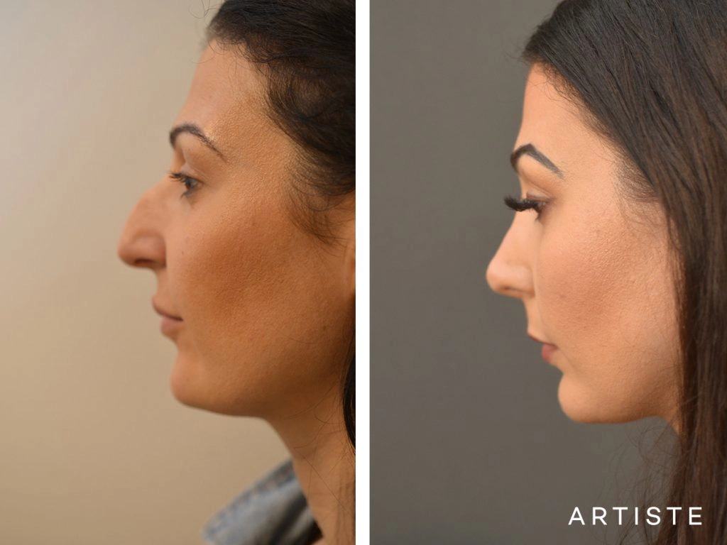 33 Years Old Dorsal + Tip Rhinoplasty