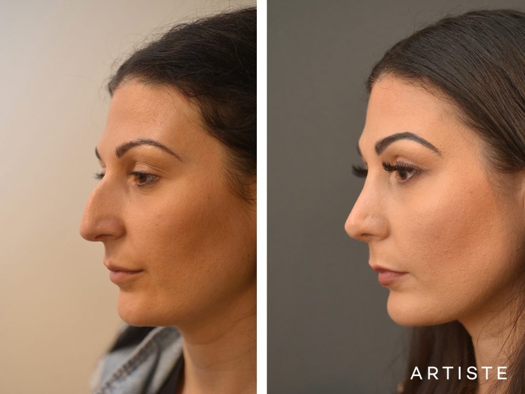 33 Years Old Dorsal + Tip Rhinoplasty