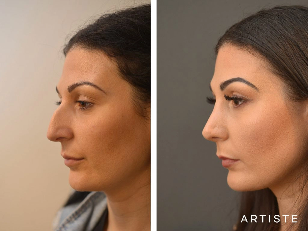 33 Years Old Dorsal + Tip Rhinoplasty