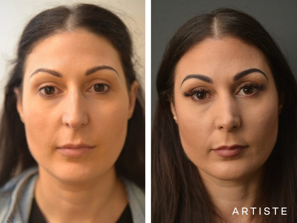 33 Years Old Dorsal + Tip Rhinoplasty