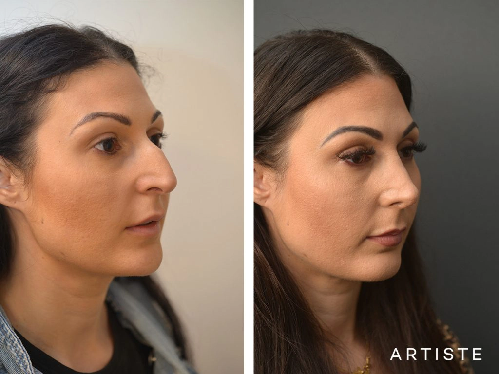 33 Years Old Dorsal + Tip Rhinoplasty