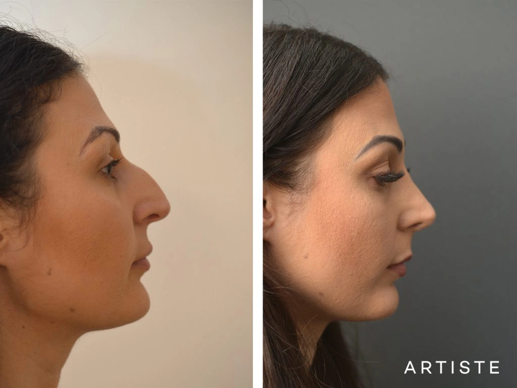 33 Years Old Dorsal + Tip Rhinoplasty