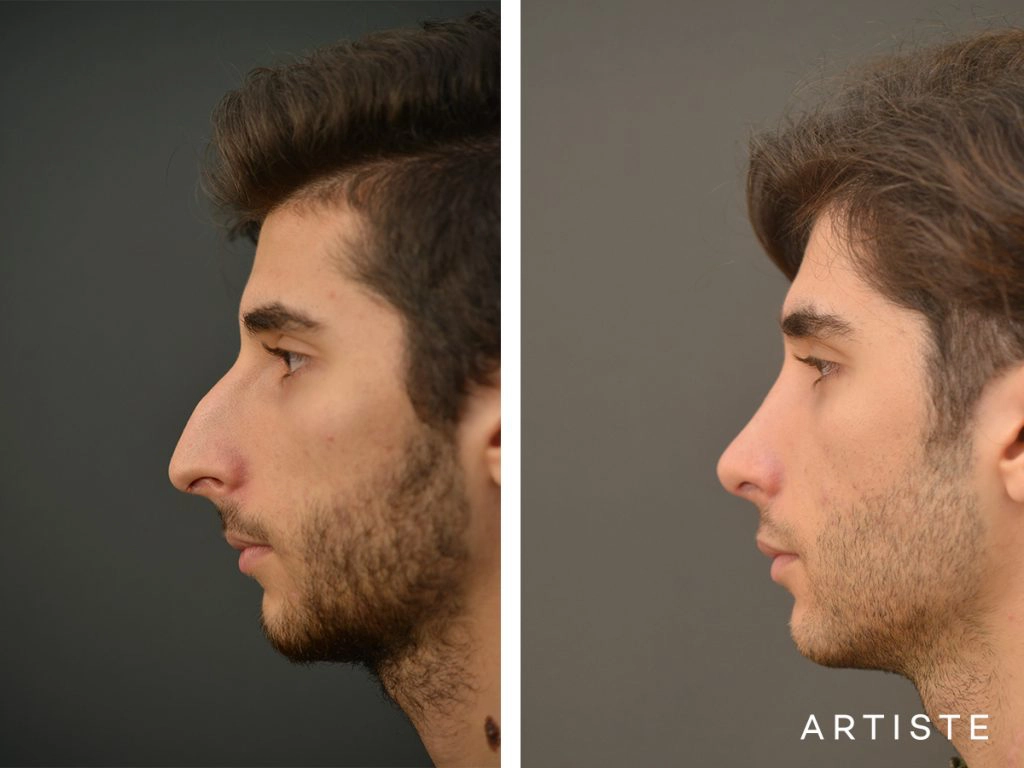 21 Years Old Male Shape (Dorsal Reduction) Nose Rhinoplasty