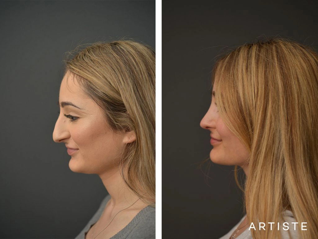  23 Years Old Female Total Nose Rhinoplasty