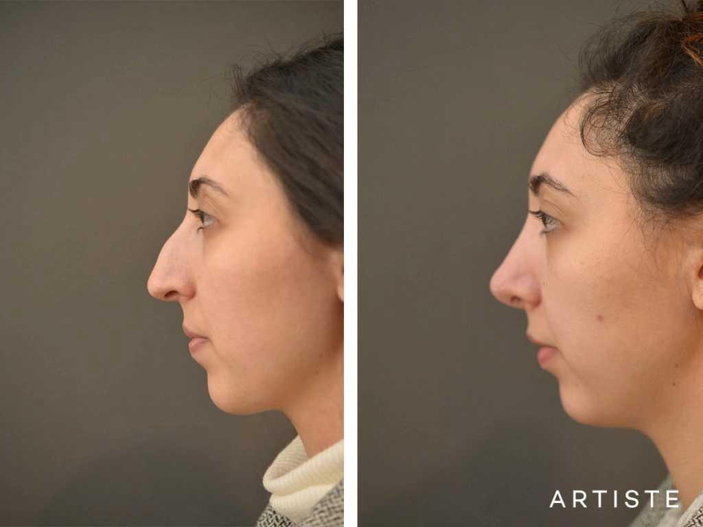 30 Years Old Female Shape (Dorsal Reduction) Nose Rhinoplasty