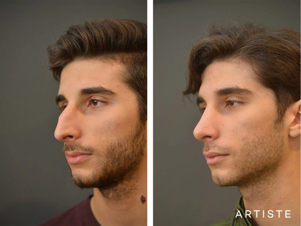 21 Years Old Male Shape (Dorsal Reduction) Nose Rhinoplasty