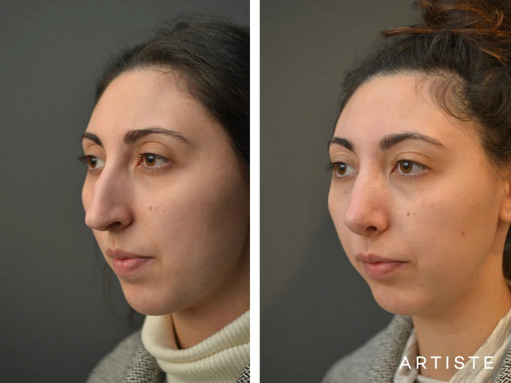 30 Years Old Female Shape (Dorsal Reduction) Nose Rhinoplasty