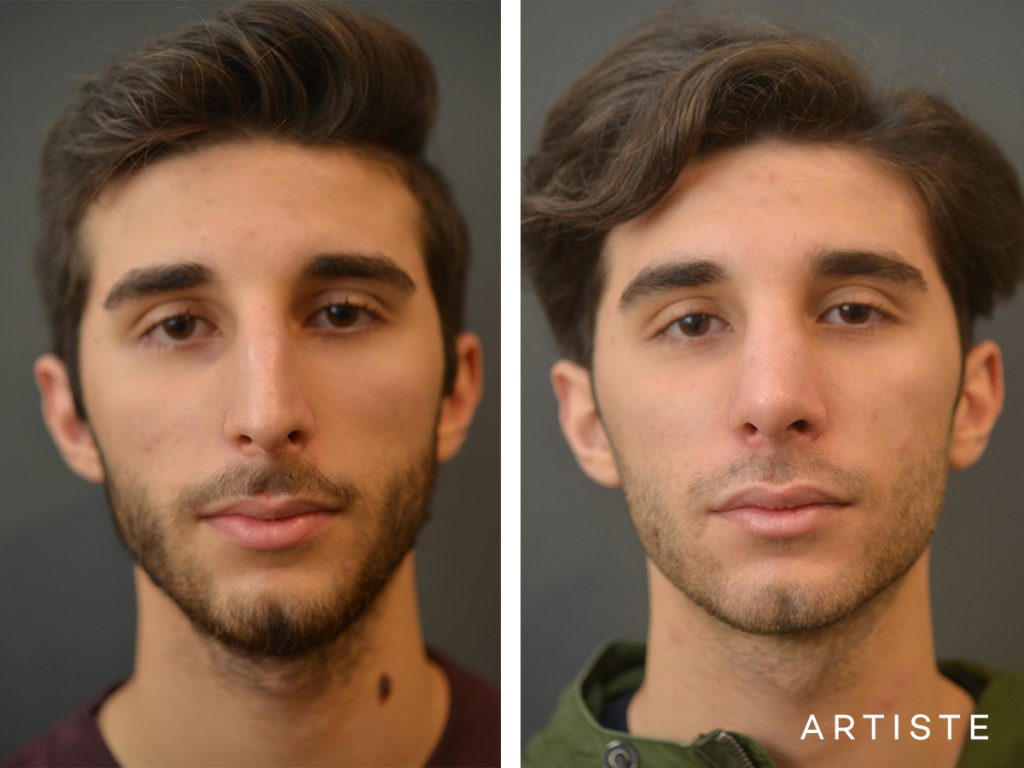 21 Years Old Male Shape (Dorsal Reduction) Nose Rhinoplasty