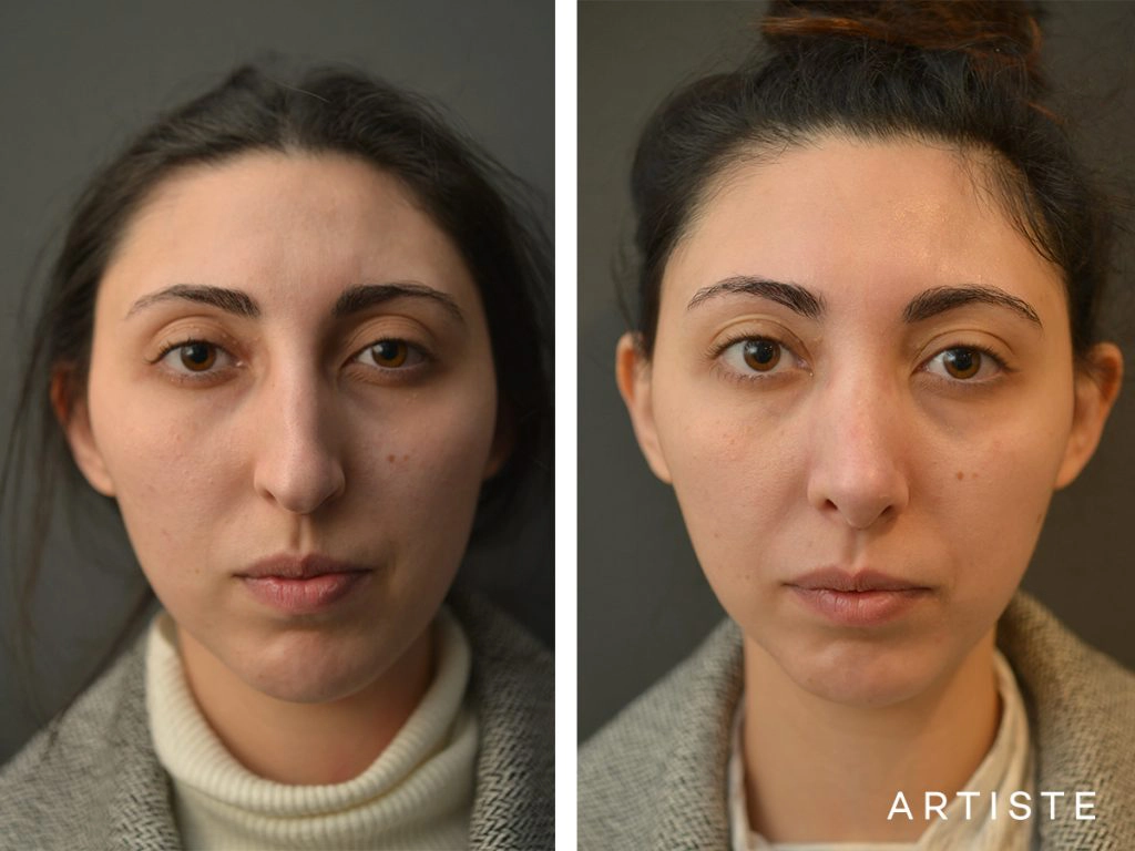 30 Years Old Female Shape (Dorsal Reduction) Nose Rhinoplasty