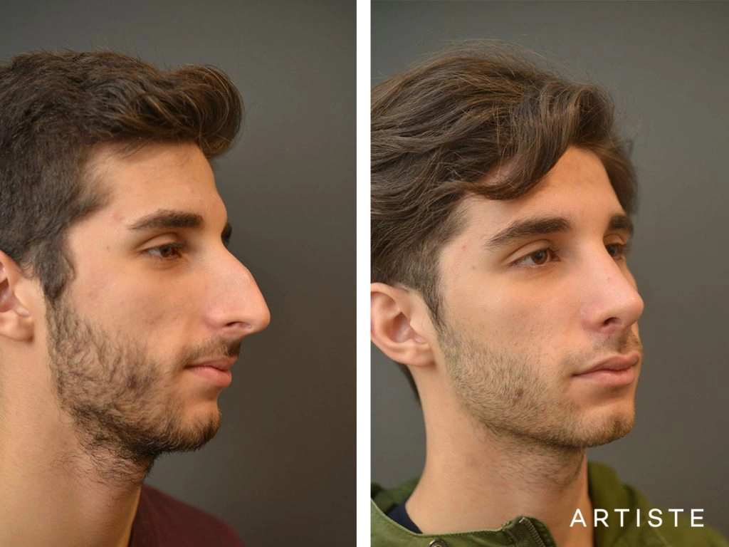 21 Years Old Male Shape (Dorsal Reduction) Nose Rhinoplasty